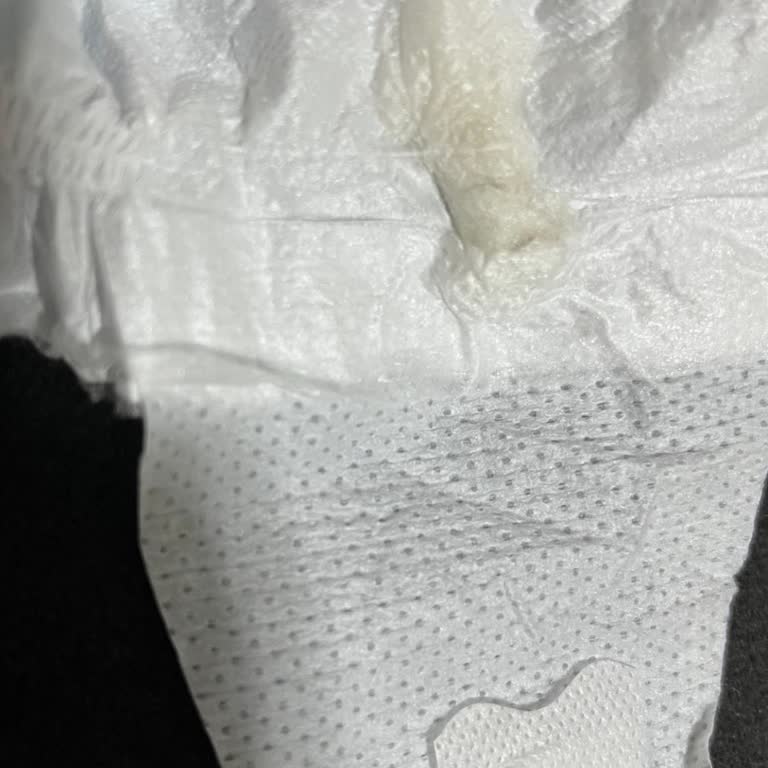 Bebek Bezinde Yabancı Madde Ve Sürekli Pişik Şikayeti