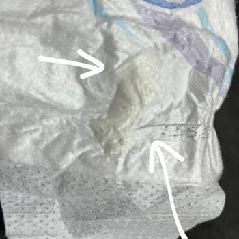 Bebek Bezinde Yabancı Madde Ve Sürekli Pişik Şikayeti