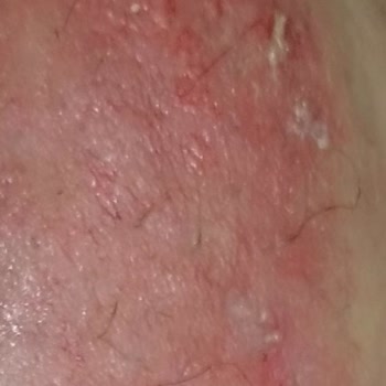 Aldığım Tüy Dökücü Krem Cildimi Yaktı Ve Mağdur Oldum