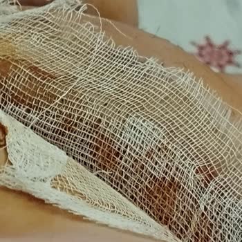 Aldığım Tüy Dökücü Krem Cildimi Yaktı Ve Mağdur Oldum