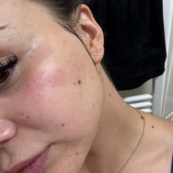 Lazer İşlem Sonrası Yüzümde Yanık Ve Leke Oluştu Çözüm Sunulmadı