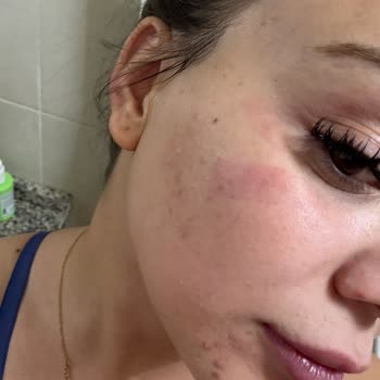 Lazer İşlem Sonrası Yüzümde Yanık Ve Leke Oluştu Çözüm Sunulmadı