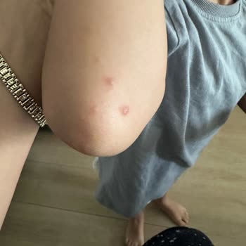 Otelin Yetersiz Hijyen Koşulları Nedeniyle Çocuklarım Hastalandı, Ücret İadesi Talep Ediyorum