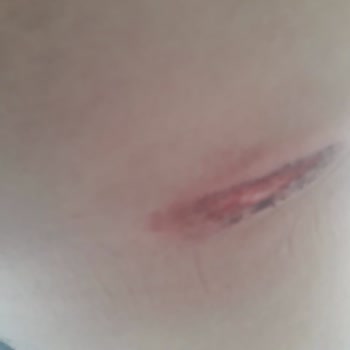 RKS RD5 Bisikletin Gidon Arızası Nedeniyle Yaşanan Kaza Ve Mağduriyet