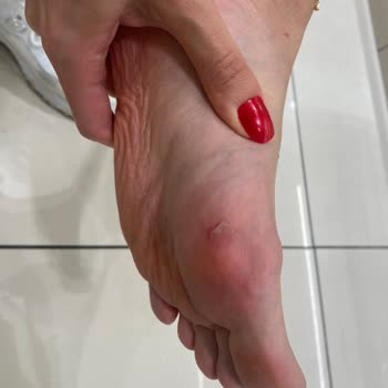 Kısa Süreli Kullanımda Ayağımda Yaraya Sebep Olan Terlik İçin İade Talebim Reddedildi