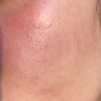 Gül Suyu Kullandıkça Cildimde Kızarıklık Ve Yanma Oluştu