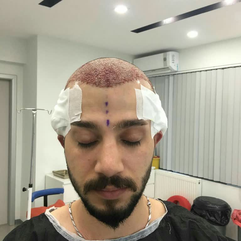 Saç Ekimi Sonrası Mağduriyet: Donör Ve Ekim Alanında Geri Dönüşü Olmayan Hasar