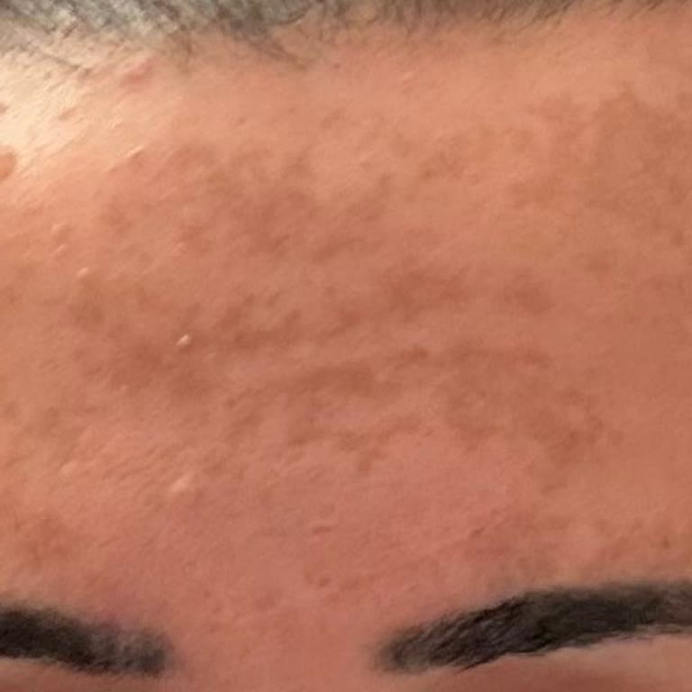 Cilt Bakımı Sonrası Lekeler Arttı, Ücret İadesi Talebim Cevapsız Kaldı