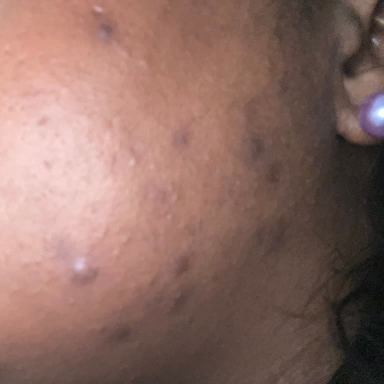 Reacción al protector solar La Roche-Posay Anthelios Uv Mune 400 50+