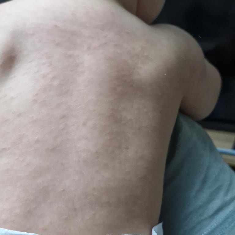 Bebeğimde Dentigel Kullanımı Sonrası Alerjik Reaksiyon Ve Endişe