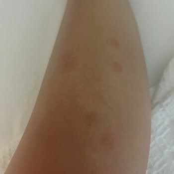 Otel Konaklamasında Tahta Kurusu Problemi Ve İade Talebi