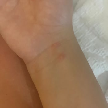 Otel Konaklamasında Tahta Kurusu Problemi Ve İade Talebi