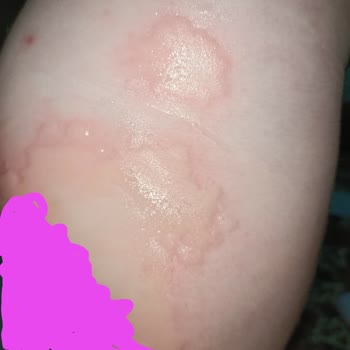 Yumoş Extra Yumuşatıcı Ciltte Alerjik Reaksiyona Sebep Oldu