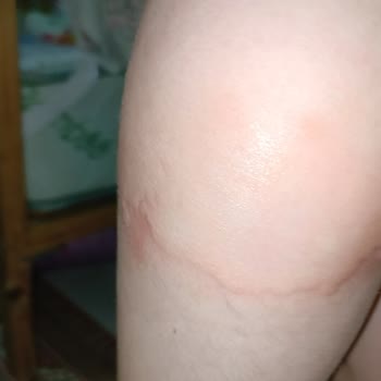 Yumoş Extra Yumuşatıcı Ciltte Alerjik Reaksiyona Sebep Oldu