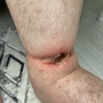 Haseki Hastanesi Yoğun Bakımda Aşırı Sıkı Bağlama Nedeniyle Babamın Ayaklarında Ciddi Yaralar Oluştu