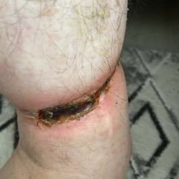 Haseki Hastanesi Yoğun Bakımda Aşırı Sıkı Bağlama Nedeniyle Babamın Ayaklarında Ciddi Yaralar Oluştu