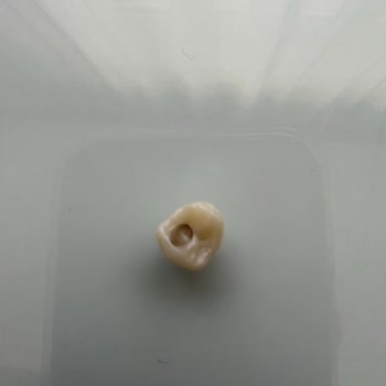 Yapılan Zirkon Diş Bir Yıl Dolmadan Düştü, Baş Ağrısı Ve İlgisizlik Yaşadım