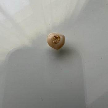 Yapılan Zirkon Diş Bir Yıl Dolmadan Düştü, Baş Ağrısı Ve İlgisizlik Yaşadım