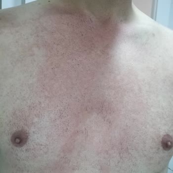 Lure Tüy Dökücü Krem Yoğun Bir Yanma Ve Batma Hissi Yaptı