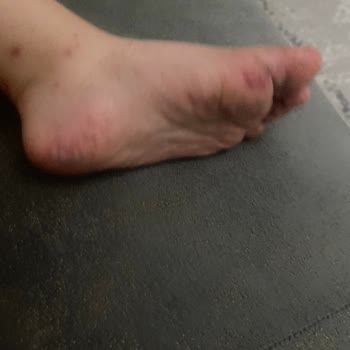 Crystal Waterworld Otel'de Ateş ve El-Ayak Sendromu Belirtileri Başladı