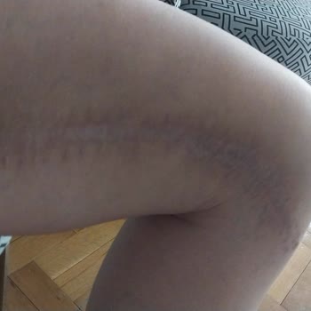 Ameliyat Sonrası Kötü Sonuçlar Ve Çözüm Bulamama Deneyimim