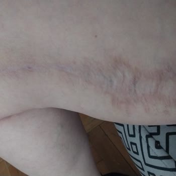 Ameliyat Sonrası Kötü Sonuçlar Ve Çözüm Bulamama Deneyimim