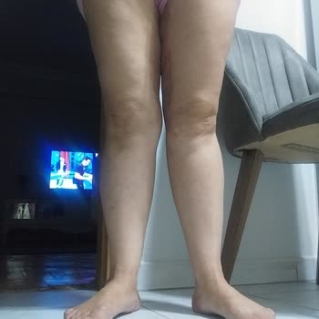 Ameliyat Sonrası Kötü Sonuçlar Ve Çözüm Bulamama Deneyimim