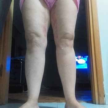 Ameliyat Sonrası Kötü Sonuçlar Ve Çözüm Bulamama Deneyimim