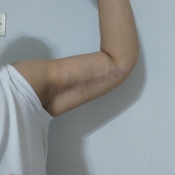 Ameliyat Sonrası Kötü Sonuçlar Ve Çözüm Bulamama Deneyimim