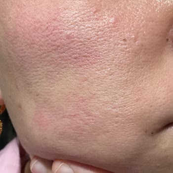 Yves Rocher Ürünleri Yüzümde Yanma Ve Kızarıklık Yaptı