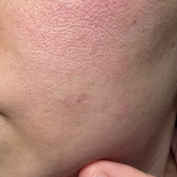 Yves Rocher Ürünleri Yüzümde Yanma Ve Kızarıklık Yaptı