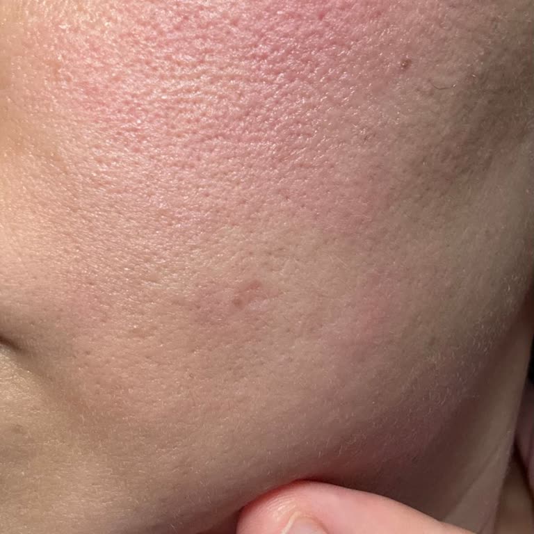 Yves Rocher Ürünleri Yüzümde Yanma Ve Kızarıklık Yaptı