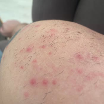 Epify Tüy Dökücü Sonrası Ciltte Kabarma Ve Kaşıntı Yaşadım Müşteri Hizmetleri Dönüş Yapmadı