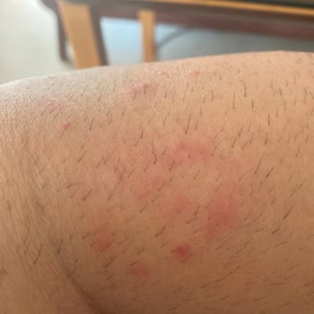 Epify Tüy Dökücü Sonrası Ciltte Kabarma Ve Kaşıntı Yaşadım Müşteri Hizmetleri Dönüş Yapmadı