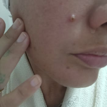 Cica Krem Kullanımı Sonrası Yoğun Sivilcelenme Ve İade Talebi