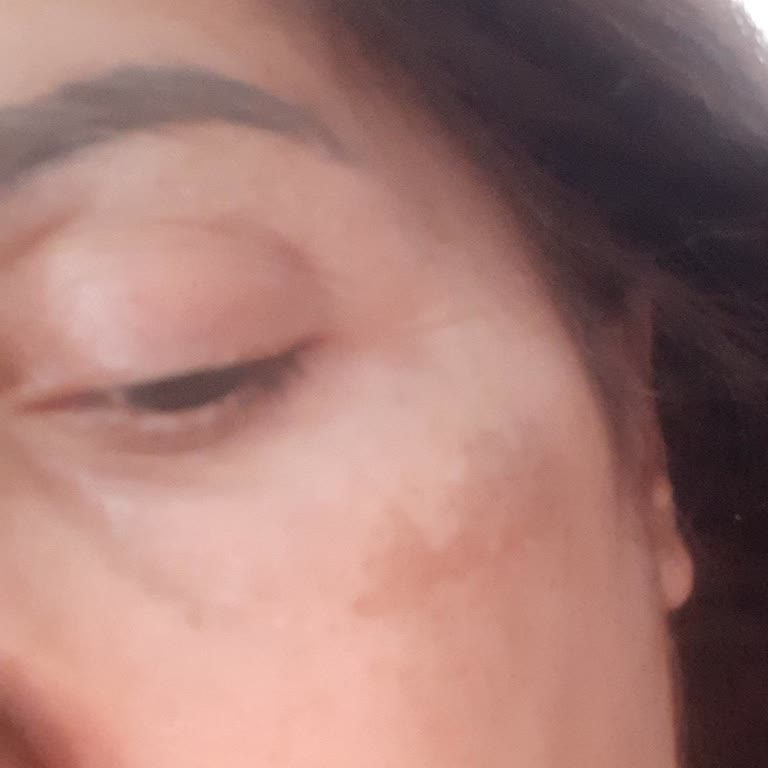 Kök Hücre Tedavisi Sonrası Göz Altında Kalıcı Lekeler Ve Klinik İlgisizliği