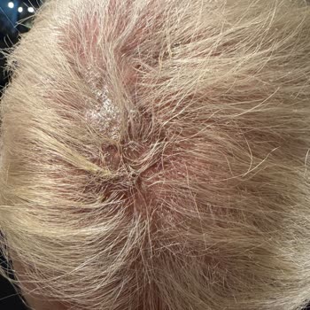 Saç Boyama İşleminde Yanık Ve İlgisizlik Mağduriyeti