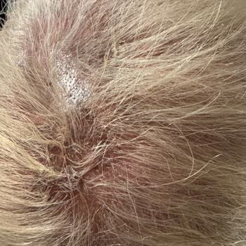 Saç Boyama İşleminde Yanık Ve İlgisizlik Mağduriyeti