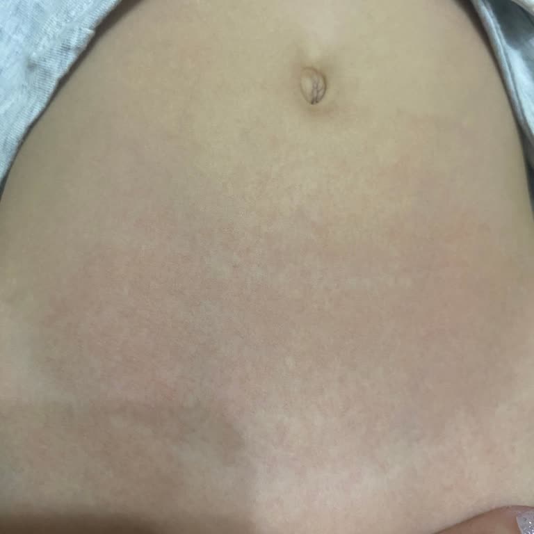 Bioderma Bebek Şampuanı Alerjik Reaksiyona Sebep Oldu, İade Talep Ediyorum