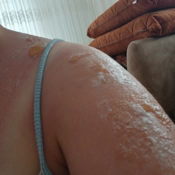 Güneş Koruyucu Ciddi Yanıklara Ve Sağlık Sorunlarına Yol Açtı