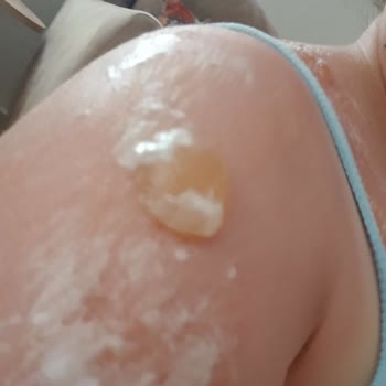 Güneş Koruyucu Ciddi Yanıklara Ve Sağlık Sorunlarına Yol Açtı