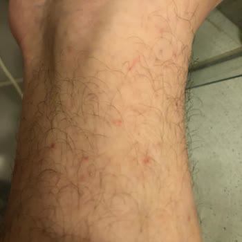 Persil Power Gel Renkliler löst starke allergische Hautreaktionen aus