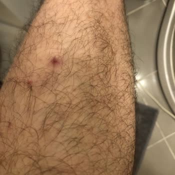 Persil Power Gel Renkliler löst starke allergische Hautreaktionen aus