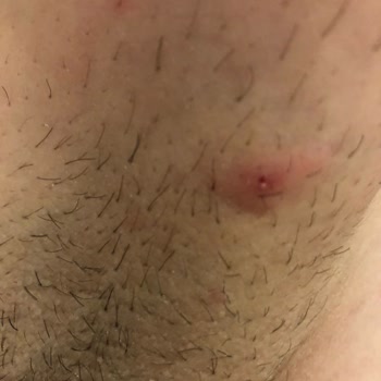 Persil Power Gel Renkliler löst starke allergische Hautreaktionen aus