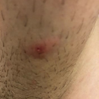 Persil Power Gel Renkliler löst starke allergische Hautreaktionen aus