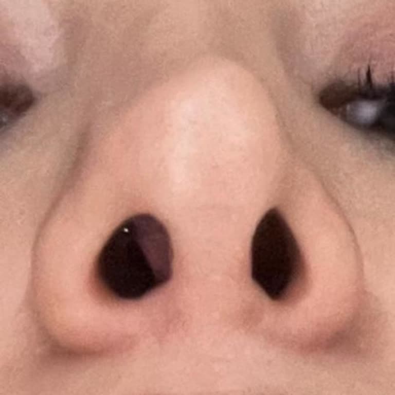 Burun Ameliyatı Sonrası Devam Eden Sorunlar Ve İletişim Eksikliği