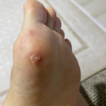 Kısa Süreli Kullanımda Ciddi Ayak Yaralanmasına Sebep Olan Terlik Ve İade Sorunu