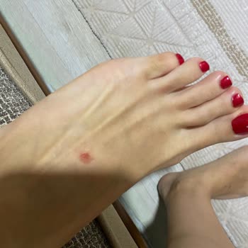 Kısa Süreli Kullanımda Ciddi Ayak Yaralanmasına Sebep Olan Terlik Ve İade Sorunu