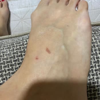 Kısa Süreli Kullanımda Ciddi Ayak Yaralanmasına Sebep Olan Terlik Ve İade Sorunu