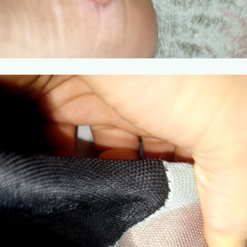 Ayakkabıdan Çıkan Parça Nedeniyle Oluşan Sağlık Sorunu ve İade Talebi